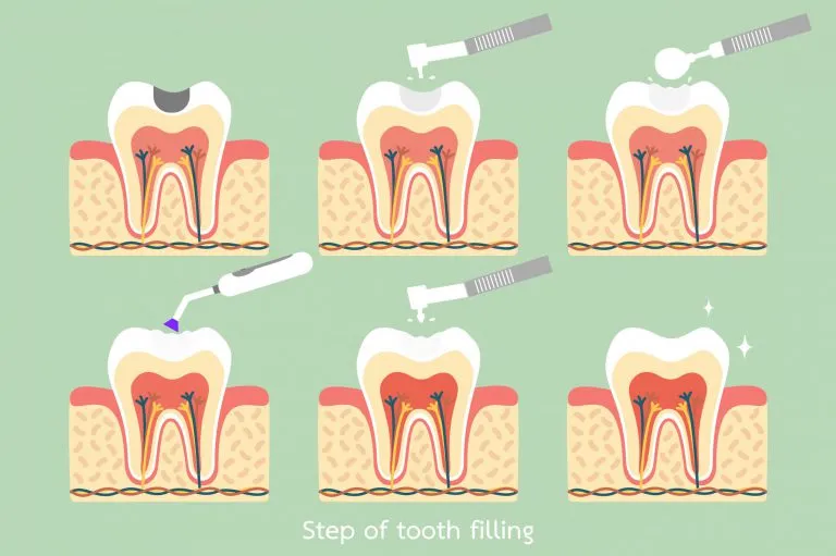 Why Does My Tooth Hurt After A Filling?