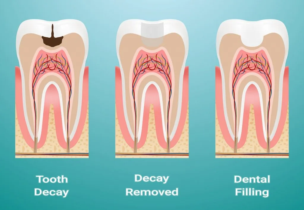 What is a Composite Filling?